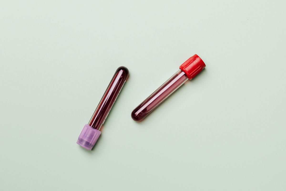 Blood test tube representing PSA test results and prostate cancer concerns