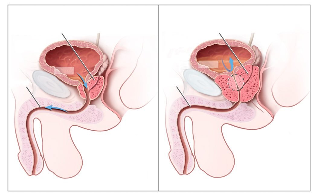 Medical illustration comparing a normal prostate with an enlarged prostate pressing on the bladder and urethra